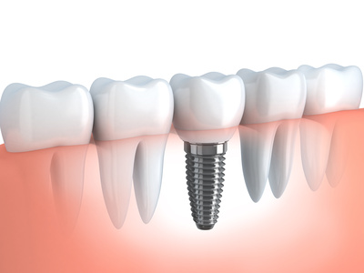 Dental Implant Toronto Bloor Dufferin