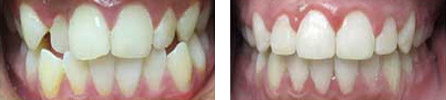 Orthodontic Braces Toronto Bloor Dufferin